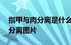 指甲与肉分离是什么原因导致 指甲根部与肉分离图片 