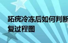 跖疣冷冻后如何判断是否痊愈 跖疣冷冻后恢复过程图 