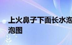 上火鼻子下面长水泡图片 上火鼻子下面长水泡图 