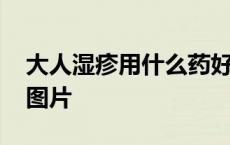 大人湿疹用什么药好得最快最有效 大人湿疹图片 