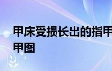 甲床受损长出的指甲图片 甲床受损长出的指甲图 