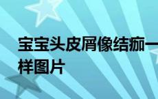 宝宝头皮屑像结痂一样图片 头皮屑像结痂一样图片 