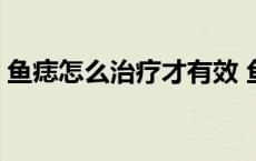 鱼痣怎么治疗才有效 鱼痣怎么去掉普通方法 