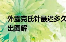 外露克氏针最迟多久必须拔掉 外露克氏针取出图解 