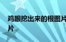 鸡眼挖出来的根图片出血 鸡眼挖出来的根图片 