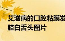 艾滋病的口腔粘膜发白和脱落图片 艾滋病口腔白舌头图片 