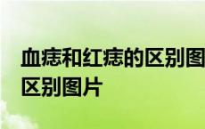 血痣和红痣的区别图片 血管瘤 血痣和红痣的区别图片 