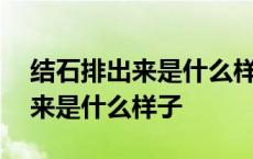 结石排出来是什么样子容易捏碎吗 结石排出来是什么样子 