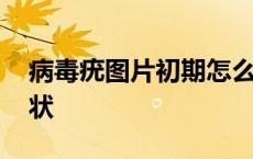 病毒疣图片初期怎么治疗 病毒疣图片初期症状 