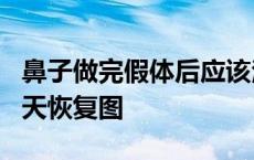 鼻子做完假体后应该注意什么 鼻子做完假体9天恢复图 