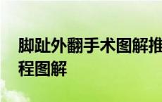 脚趾外翻手术图解推陈圣英 脚趾外翻手术过程图解 